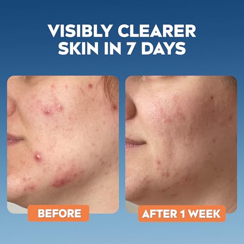 NIVEA Derma Skin Clear Scrub before-and-after skin comparison showing blemishes before and clearer skin after one week