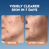 NIVEA Derma Skin Clear Scrub before-and-after skin comparison showing blemishes before and clearer skin after one week